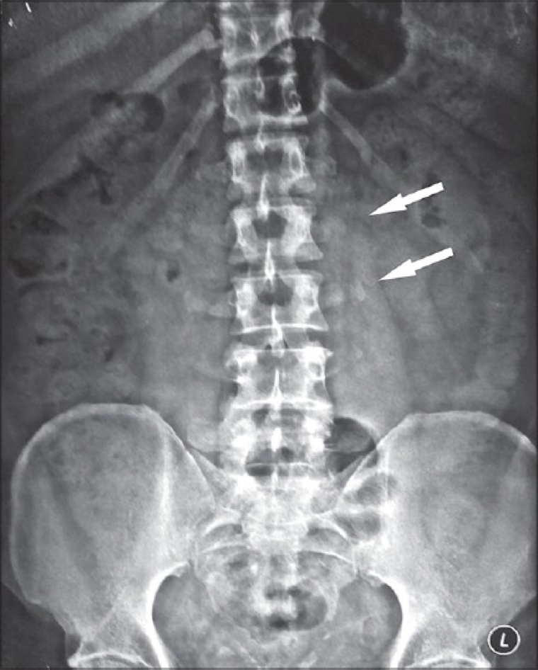 X-ray of transverse process fracture